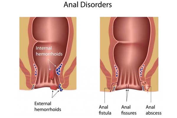 Anorectal Disorders