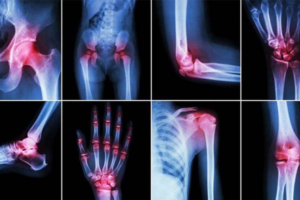 bone-and-joints problems